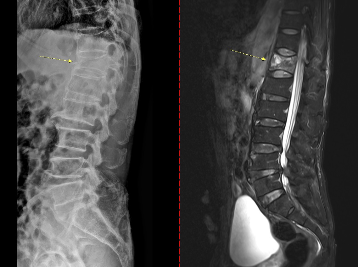 기침 한번 했는데 골절…목숨 앗아가는 침묵의 '이 질환'