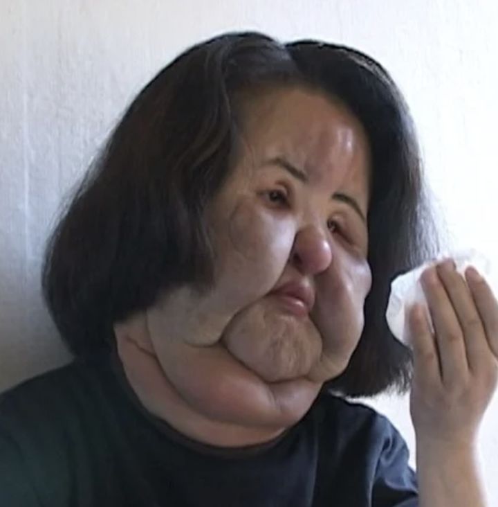 선풍기 아줌마는 왜 얼굴에 '공업용 실리콘'을 넣었나